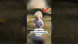 Синдром нерасчёсываемых волос #амитеш #хочуфакты