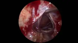 Endoscopic Endonasal Transplanum Approach for Craniopharyngioma